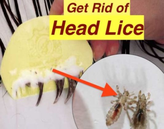 How to Get Rid of Lice? (Head Lice)