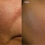 How to minimize pores make pores smaller