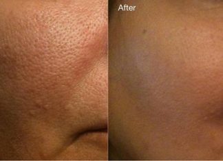 How to minimize pores make pores smaller