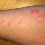 How to treat bed bug bites