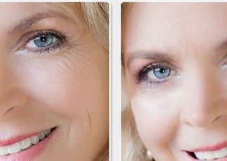 Natural Home Remedies for Wrinkles Around Eye