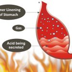 Natural cure for burning sensation in stomach