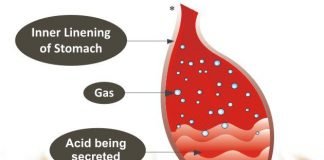 Natural cure for burning sensation in stomach