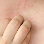 Remedies for itchy bumps
