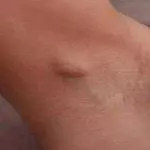 Home Remedies To Get Rid of Painful Lumps in Armpit home remedies to get rid of painful lumps in armpit