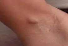 Home Remedies To Get Rid of Painful Lumps in Armpit home remedies to get rid of painful lumps in armpit