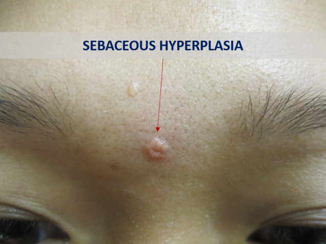 Get Rid of Sebaceous Hyperplasia