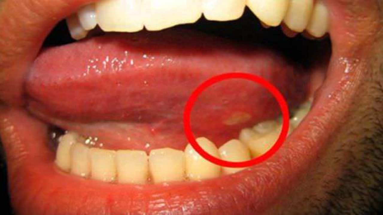 Canker Sore Medicine For Tongue - MedicineWalls