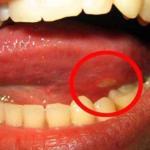 Home remedies for canker sore on tongue in mouth