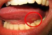 Home remedies for canker sore on tongue in mouth