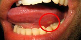 Home remedies for canker sore on tongue in mouth