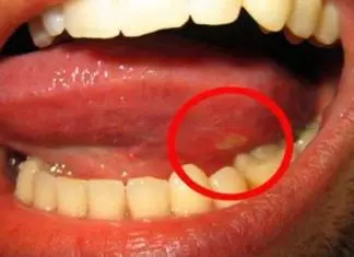 Home remedies for canker sore on tongue in mouth