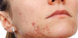 get rid of hormonal acne