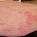 how to get rid of scabies