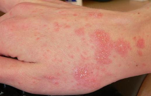 how to get rid of scabies