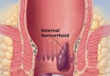 hemorrhoids last
