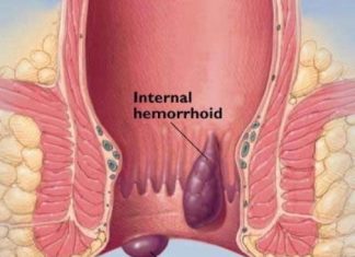 hemorrhoids last