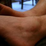 remedies for swollen ankles