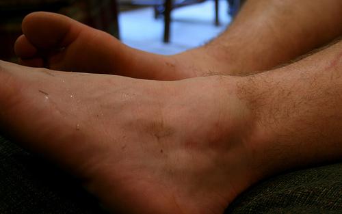 remedies for swollen ankles