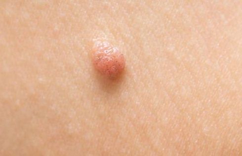 how to remove a skin tag naturally