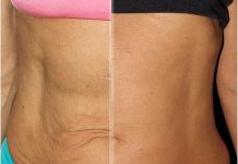 how to tighten loose skin