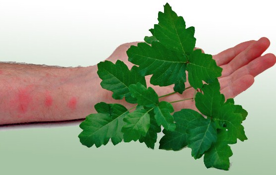 treat poison ivy