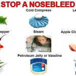 How to stop a nosebleed