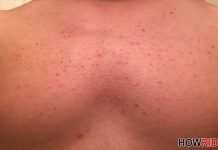 get rid of a rash
