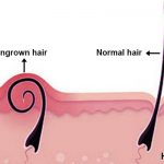 get rid of ingrown hair