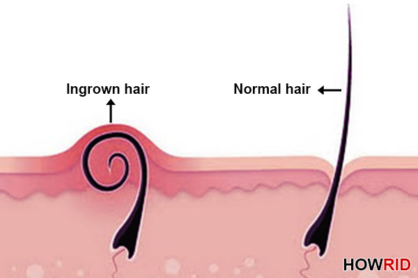 get rid of ingrown hair