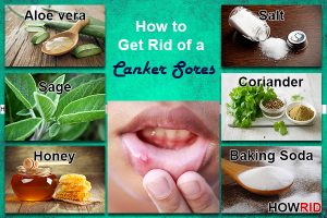 How to Get Rid of a Canker Sore Overnight and Fast?