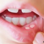 how to get rid of a canker sores