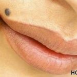 home remedies to remove moles  fast and naturally