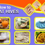 how to treat hives 1