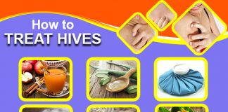 how to treat hives naturally and fast