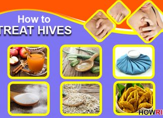 how to treat hives naturally and fast