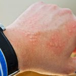 how to treat hives naturally and fast