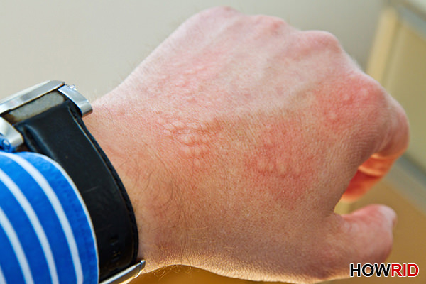 how to treat hives naturally and fast