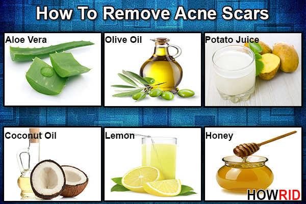 home remedies to remove acne scars