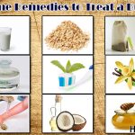 home remedies to treat a burn
