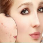 homemade acne scar treatment 1