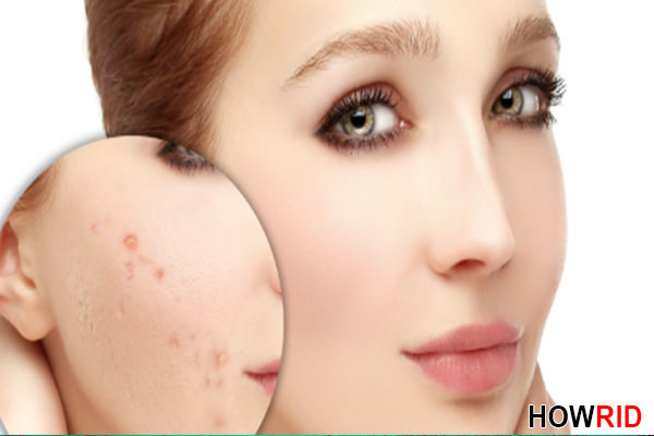 homemade acne scar treatment 1