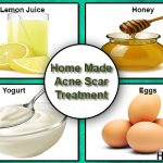 homemade acne scars treatment
