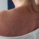 how to stop peeling skin from sunburn