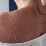 How To Stop Peeling Skin From Sunburn? how to stop peeling skin from sunburn
