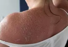 how to stop peeling skin from sunburn