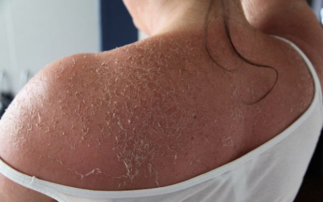 how to stop peeling skin from sunburn